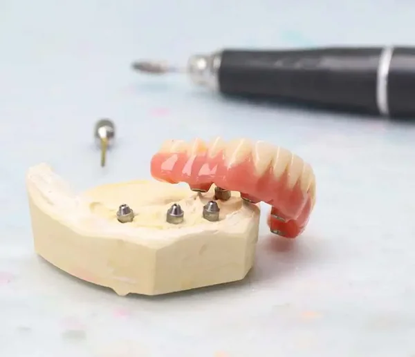 Zahnmodell mit eingesetzten Implantaten, auf denen eine herausnehmbare Prothese befestigt wird. Im Hintergrund liegt ein zahn&auml;rztliches Instrument